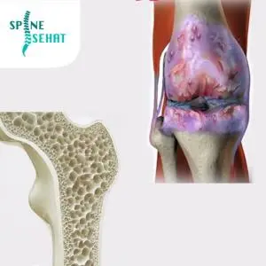 Pengapuran vs Pengeroposan Tulang