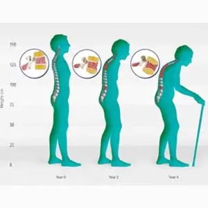 Pengapuran vs Pengeroposan Tulang