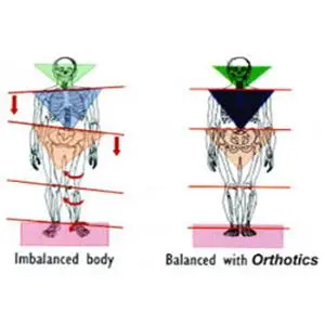 Ketahui Gejala Flat Foot (Kaki Datar) dan Cara Mengatasinya