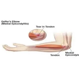 Cedera Olahraga Golfer Syndrome, Tennis Elbow dan Penanganannya