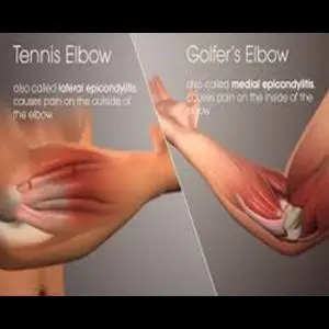 Cedera Olahraga Golfer Syndrome, Tennis Elbow dan Penanganannya