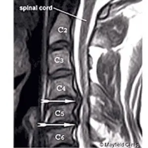 Penanganan Sakit Leher oleh Painfree Sehat