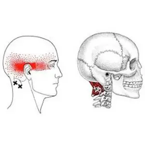 1. Myofascial pain syndrome 